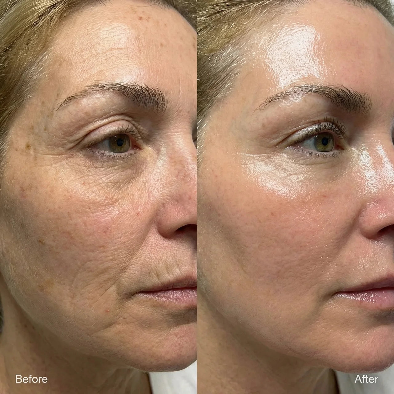 VoluGlow™ Silk Peptide Lift System