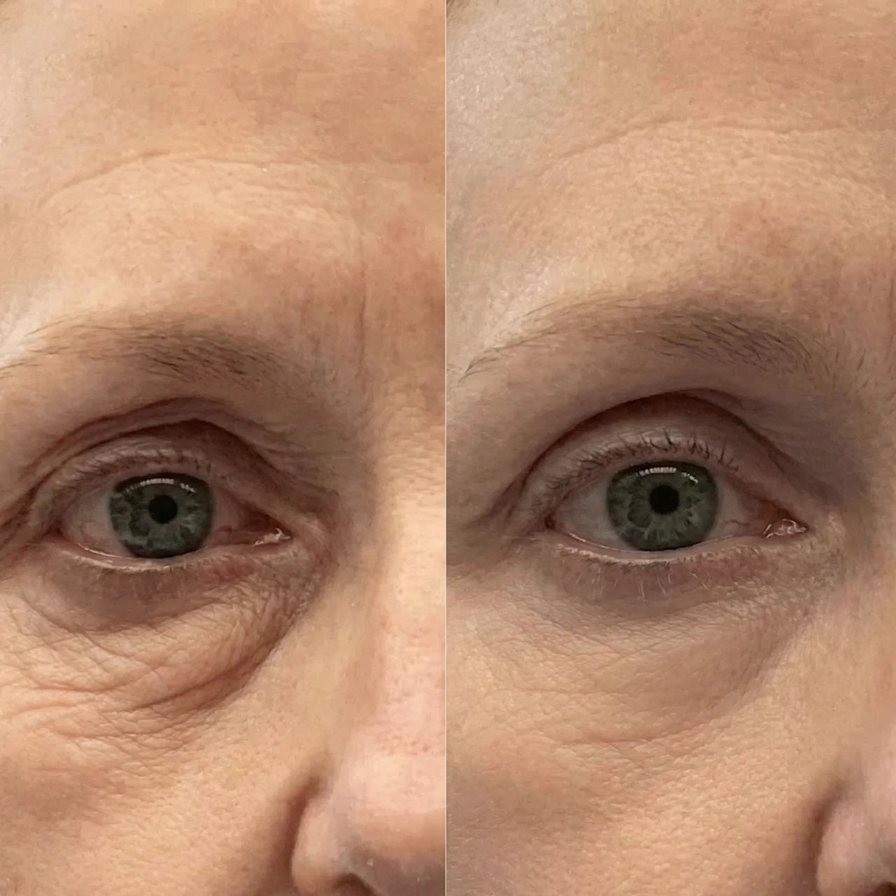 VoluGlow™ Silk Peptide Lift System
